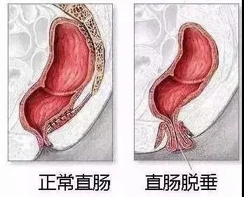 运城众泰肛肠医院：肛门异物感是什么病