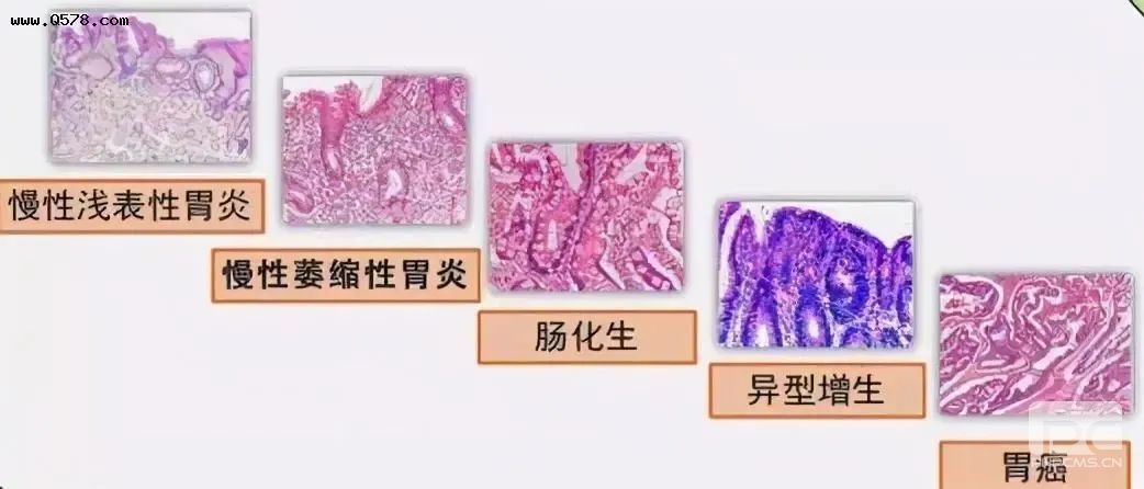 运城众泰肛肠医院：幽门螺杆菌超标信号