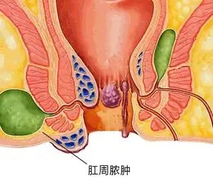 运城众泰肛肠医院：肛周脓肿可以自愈吗？