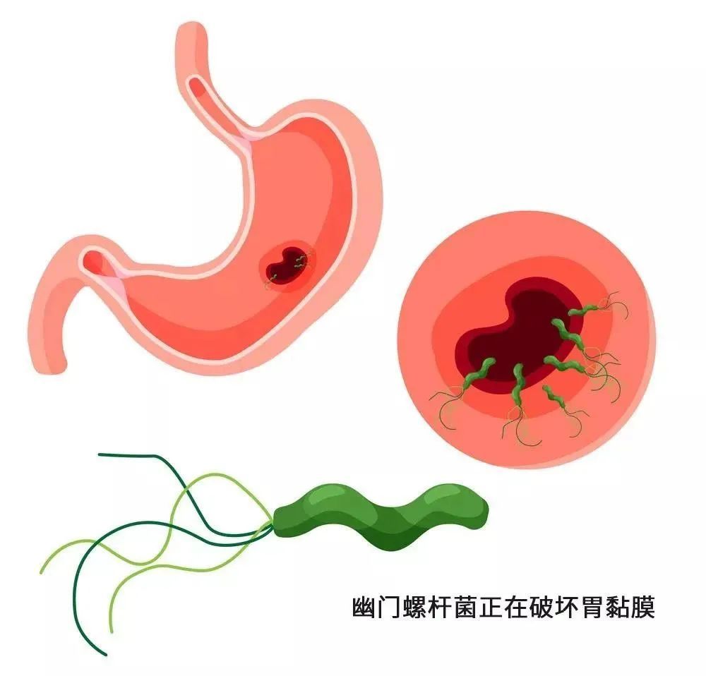 运城众泰肛肠医院：幽门螺杆菌的传染途径有哪些?