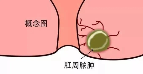 运城众泰肛肠医院：什么是肛周脓肿？