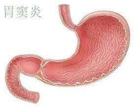 运城众泰肛肠医院：胃窦炎是不是就是胃炎？