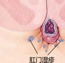 运城众泰肛肠医院：肛门湿疹是由哪些原因引起的？