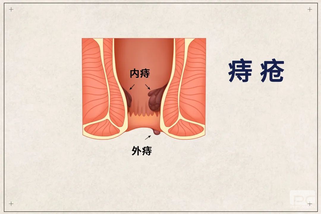运城众泰肛肠医院：痔疮疼痛难耐该如何缓解?