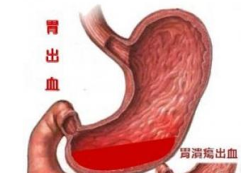 运城众泰肛肠医院：一起来看看胃出血有什么症状表现