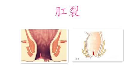 运城众泰肛肠医院：早期肛裂怎么办最好?