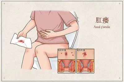运城众泰肛肠医院：肛周瘙痒、破溃、流脓？千万别拖！
