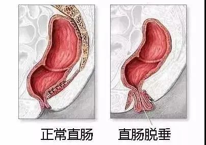 运城众泰肛肠医院：“脱肛”的症状变现是什么？