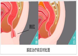 运城众泰肛肠医院：生活中要从哪些方面预防“脱肛”