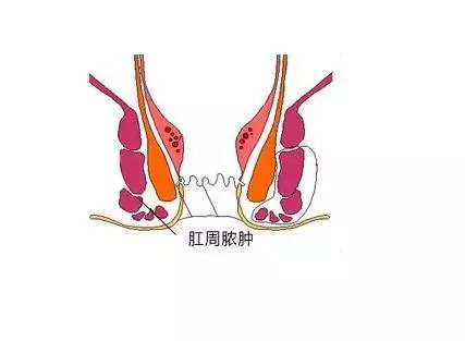 肛周脓肿