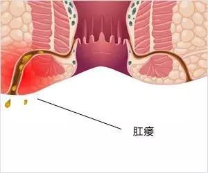 运城众泰肛肠医院:比痔疮危害更大的肛肠疾病——肛瘘