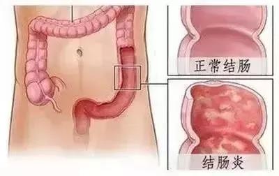 运城众泰肛肠医院:慢性结肠炎的症状有哪些?