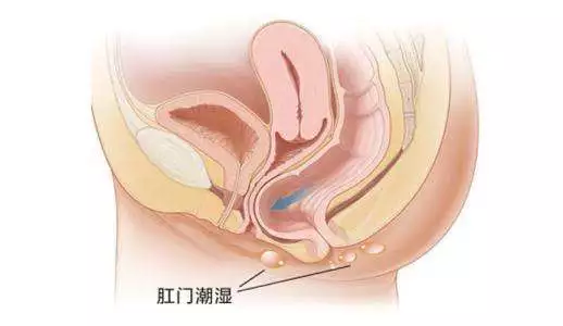 运城众泰肛肠医院:肛周湿疹怎么治好?