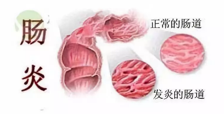 运城众泰肛肠医院：老是拉肚子，可能是这个病