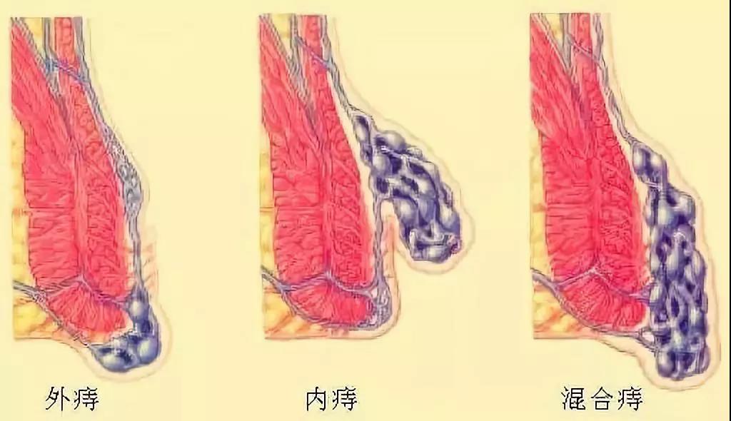 运城众泰肛肠医院:得了痔疮就一定会疼?不一定!