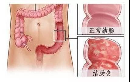 运城众泰肛肠医院：拉肚子半月不止，医生提醒：要当心溃疡性结肠炎
