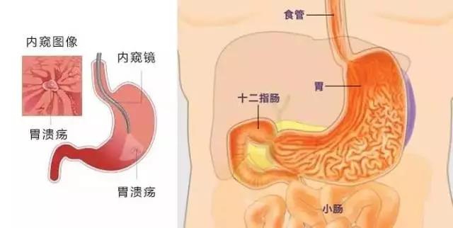 运城众泰肛肠医院：刷牙就能杀死幽门螺杆菌？