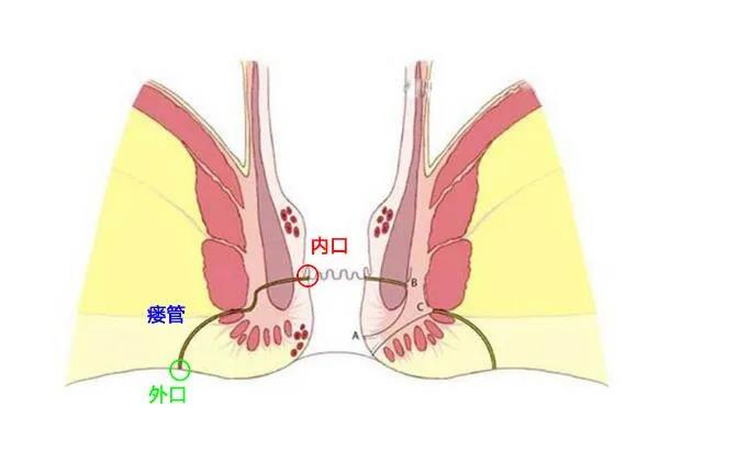 运城众泰肛肠医院：肛瘘会引发哪些疾病？