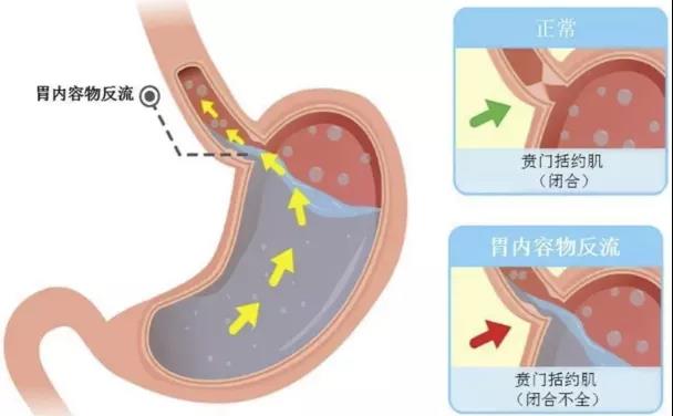 运城众泰肛肠医院：反酸烧心！胃食管反流的“杀伤力”