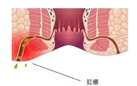运城众泰肛肠医院：肛瘘疾病是什么原因引起的？